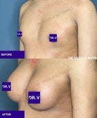 Gender affirming, MTF, Male to Female Breast Augmentation