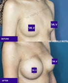 Gender affirming, MTF, Male to Female Breast Augmentation