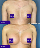 Gender affirming, MTF, Male to Female Breast Augmentation