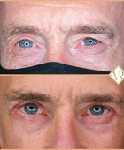 Eyelid surgery