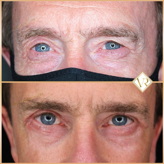 Eyelid surgery