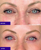 Eyelid surgery