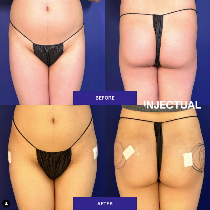 Non-surgical Buttocks/Hip Augmentation