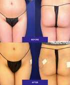 Non-surgical Buttocks/Hip Augmentation