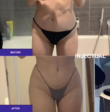 Non-surgical Buttocks/Hip Augmentation