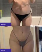 Non-surgical Buttocks/Hip Augmentation